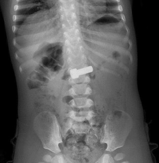 Врачи извлекли болт из желудка годовалого ребенка