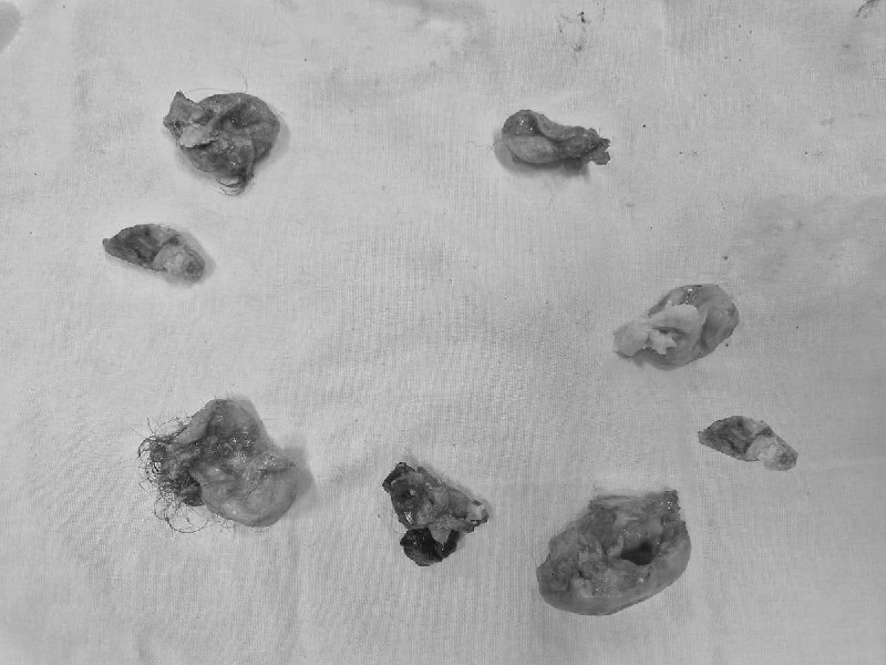 В Московской области девушке удалили восемь кист с волосами и жиром