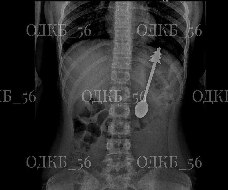 Ребёнок проглотил ложку в Оренбургской области