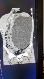 Удаление огромной почки у подростка в Новосибирске