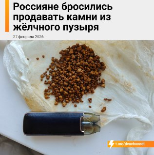 Россияне продают камни из желчного пузыря