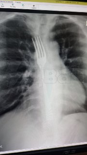 Женщина проглотила вилку, пытаясь вызвать рвоту