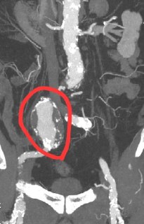 В Раменской больнице спасли пациента с гигантской аневризмой