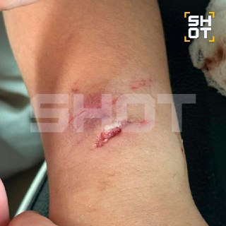 Ребенка укусила обезьяна во Вьетнаме: потребовалась госпитализация и вакцинация