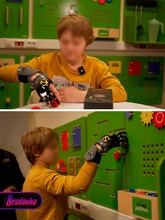 Мальчик из Красногорска, потерявший пальцы из-за взрыва, получил протез