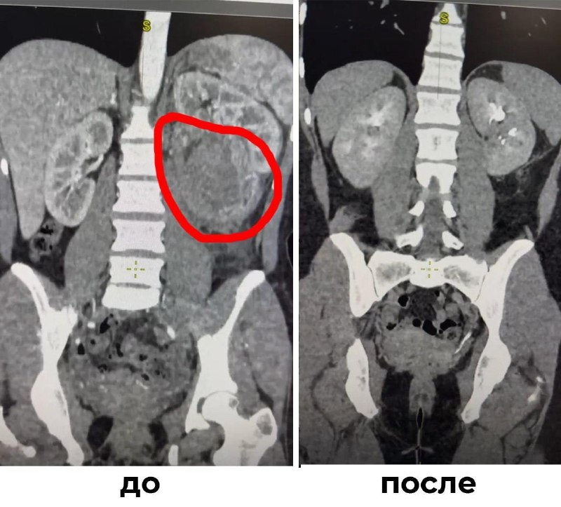 Мытищинские врачи сохранили почку пациентке с разрывом опухоли