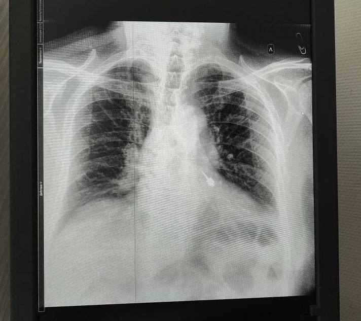 Мужчина проглотил стоматологический бур во время лечения в Подмосковье