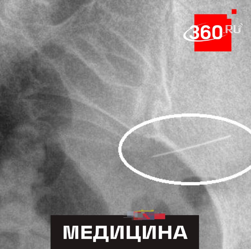 Врачи извлекли швейную иглу из желудка девушки в Красногорске