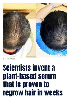 В Китае создали сыворотку от облысения, пробуждающую спящие луковицы