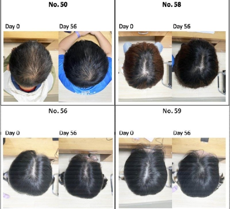 Учёные создали препарат для роста волос с эффективностью 25%