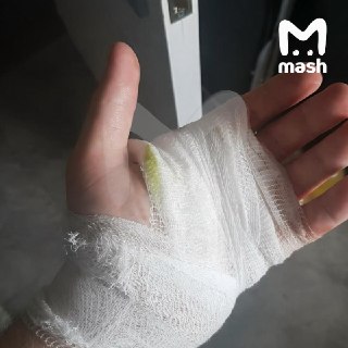 Петарда взорвалась в руках у подростка в Перми