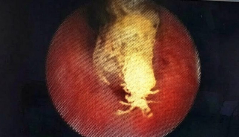 Житель Петербурга госпитализирован после попытки использовать церковную свечу в качестве медицинского лайфхака