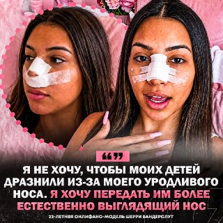 Онлифанщица сделала ринопластику ради красоты носов своих будущих детей