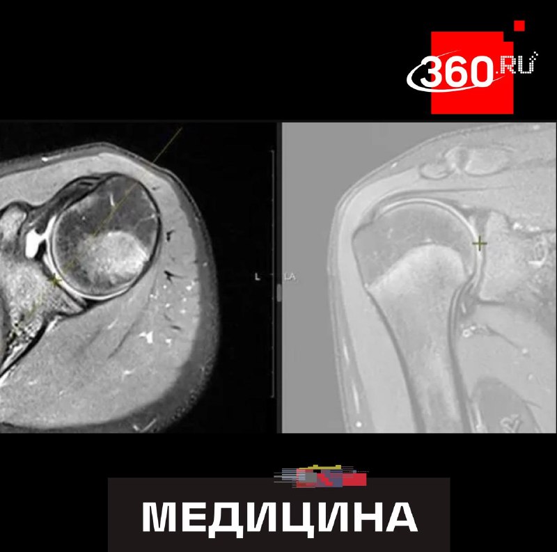 В Подмосковье юной чирлидерше восстановили плечо после неудачного трюка