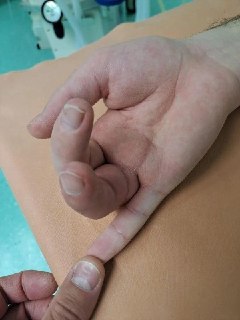 В Амурской области хирурги восстановили функцию пальца после травмы пилой