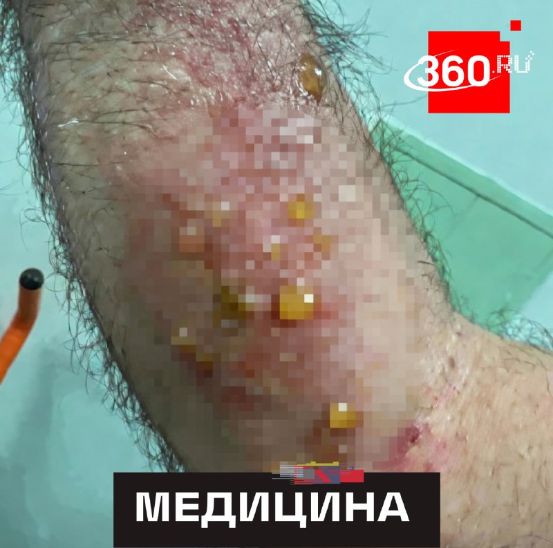 Москвич пострадал от укуса гадюки при попытке «прокачать» иммунитет