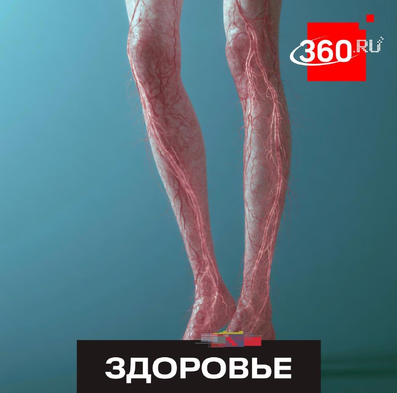 Флеболог предупредил о скрытых признаках варикоза и дал советы по профилактике