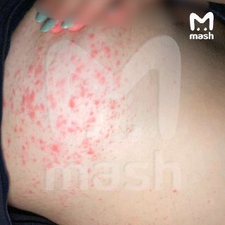 Опасные кремы для увеличения груди травят зумеров