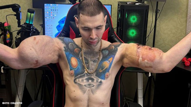 Блогеру «Руки-Базуки» грозит ампутация из-за осложнений после введения синтола