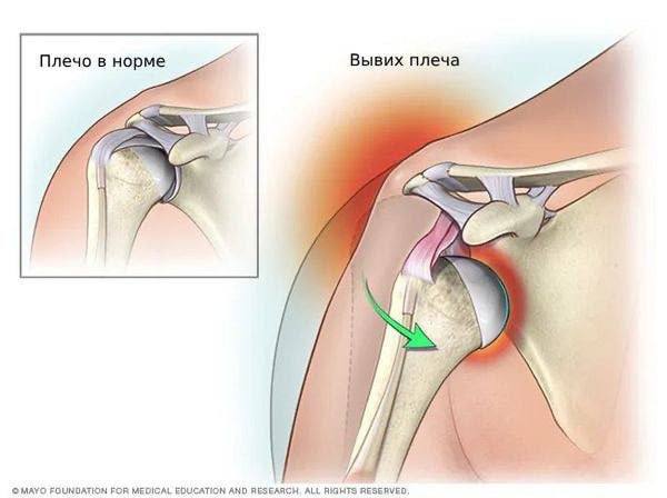 Вывих плеча: причины, симптомы и первая помощь