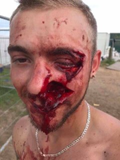 Челюстно-лицевые ранения: признаки и первая помощь